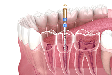 根管治療 (歯内療法)